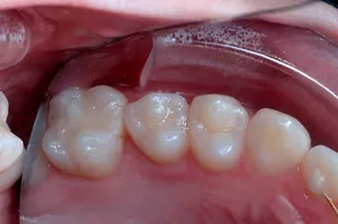 K&K OCCLUSAL RETRACTOR