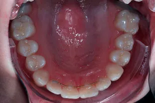 K&K OCCLUSAL RETRACTOR